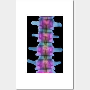 Lumbar spine, X-ray (P116/0393) Posters and Art